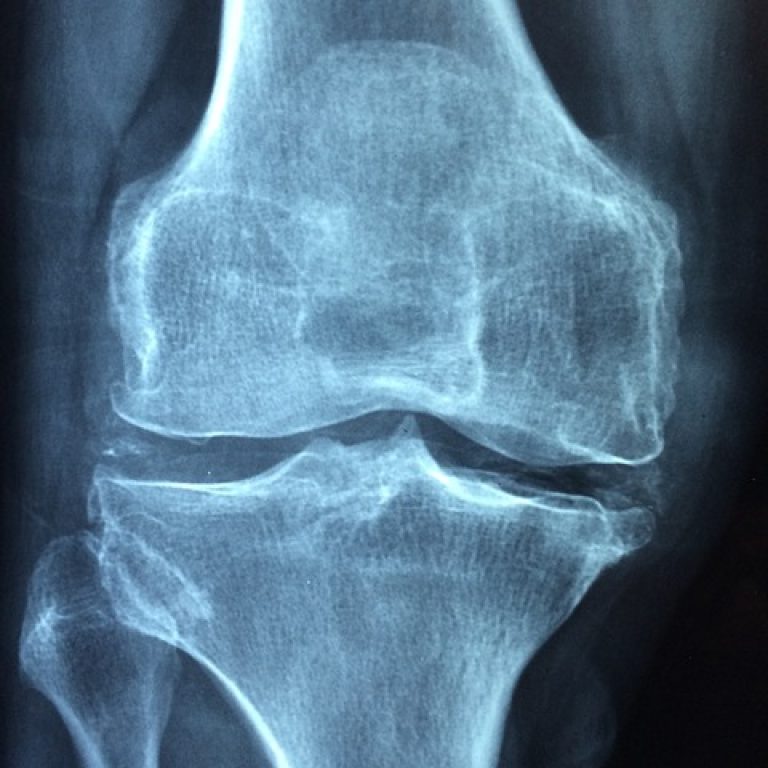 roentgenbild-von-knie-mit-arthrose